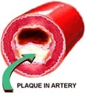 Arterial Blockage