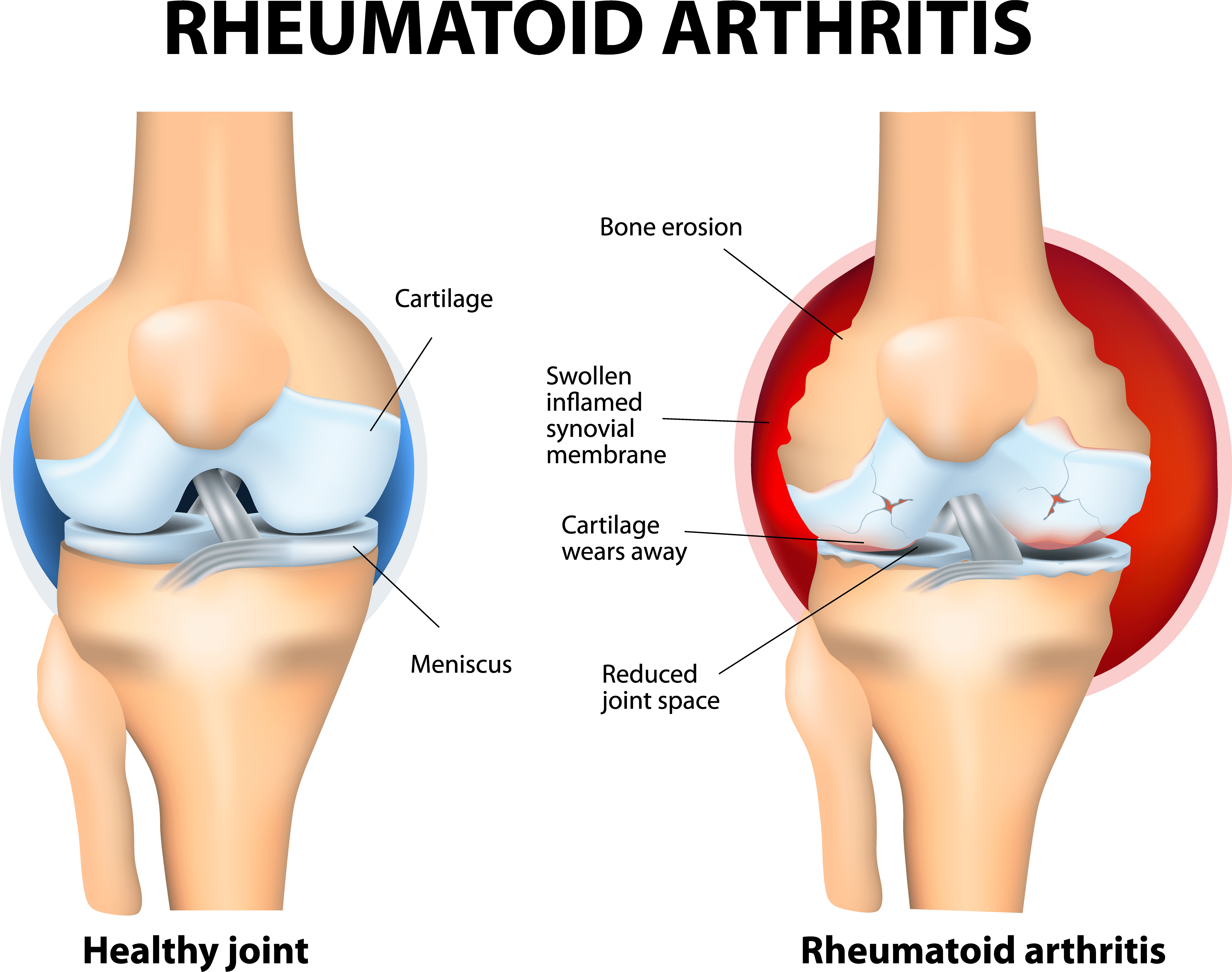 RA Joint_AdobeStock_70814564